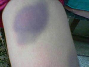 bruise.jpg